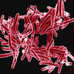 Tuberculosis